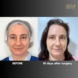 Before and after mini facelift results at ID Clinic Bangkok, visible facial rejuvenation in 10 days