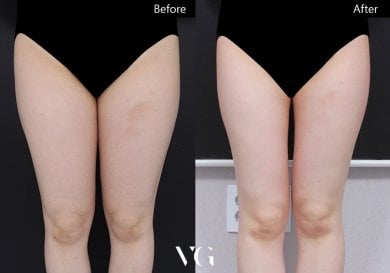 Vorher-nachher-Liposuktionsergebnis bei VG Plastic Surgery, schlankere Oberschenkel, bessere Kontur
