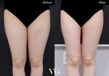 Vorher-nachher-Liposuktionsergebnis bei VG Plastic Surgery, schlankere Oberschenkel, bessere Kontur