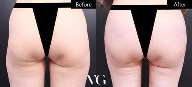 Before and after liposuction results at VG Plastic Surgery, improved body contour and shape