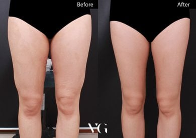 Результаты липосакции до и после в VG Plastic Surgery: стройнее бедра и гладкая кожа