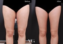 Результаты липосакции до и после в VG Plastic Surgery: стройнее бедра и гладкая кожа