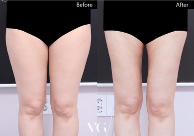 Resultados de liposucción antes y después en VG Plastic Surgery, muslos más delgados