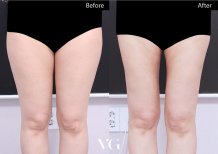 Resultados de liposucción antes y después en VG Plastic Surgery, muslos más delgados