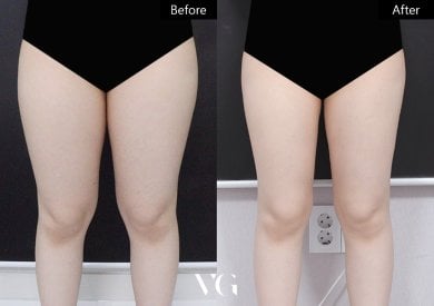 Результаты липосакции до и после в VG Plastic Surgery: стройные бедра, улучшенный контур