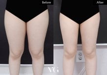 Результаты липосакции до и после в VG Plastic Surgery: стройные бедра, улучшенный контур