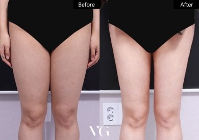 Before and after liposuction results at VG Plastic Surgery, visible thigh contour improvement