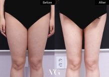 Before and after liposuction results at VG Plastic Surgery, visible thigh contour improvement