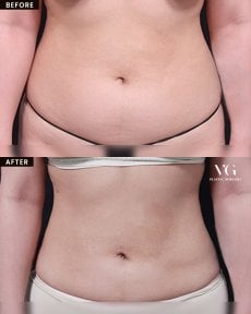 Before and after liposuction results at VG Plastic Surgery, visible abdominal contour improvement