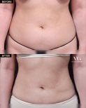Before and after liposuction results at VG Plastic Surgery, visible abdominal contour improvement