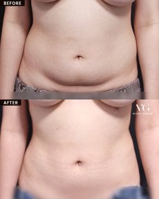 Before and after liposuction results at VG Plastic Surgery, visible abdominal contour improvement