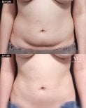 Before and after liposuction results at VG Plastic Surgery, visible abdominal contour improvement