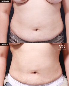 Vorher-nachher-Liposuktionsergebnis bei VG Plastic Surgery, sichtbare Bauchkonturverbesserung