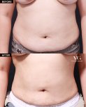 Vorher-nachher-Liposuktionsergebnis bei VG Plastic Surgery, sichtbare Bauchkonturverbesserung