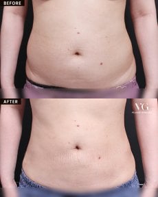 Before and after liposuction results at VG Plastic Surgery – slimmer abdomen contour improvement