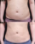Before and after liposuction results at VG Plastic Surgery – slimmer abdomen contour improvement