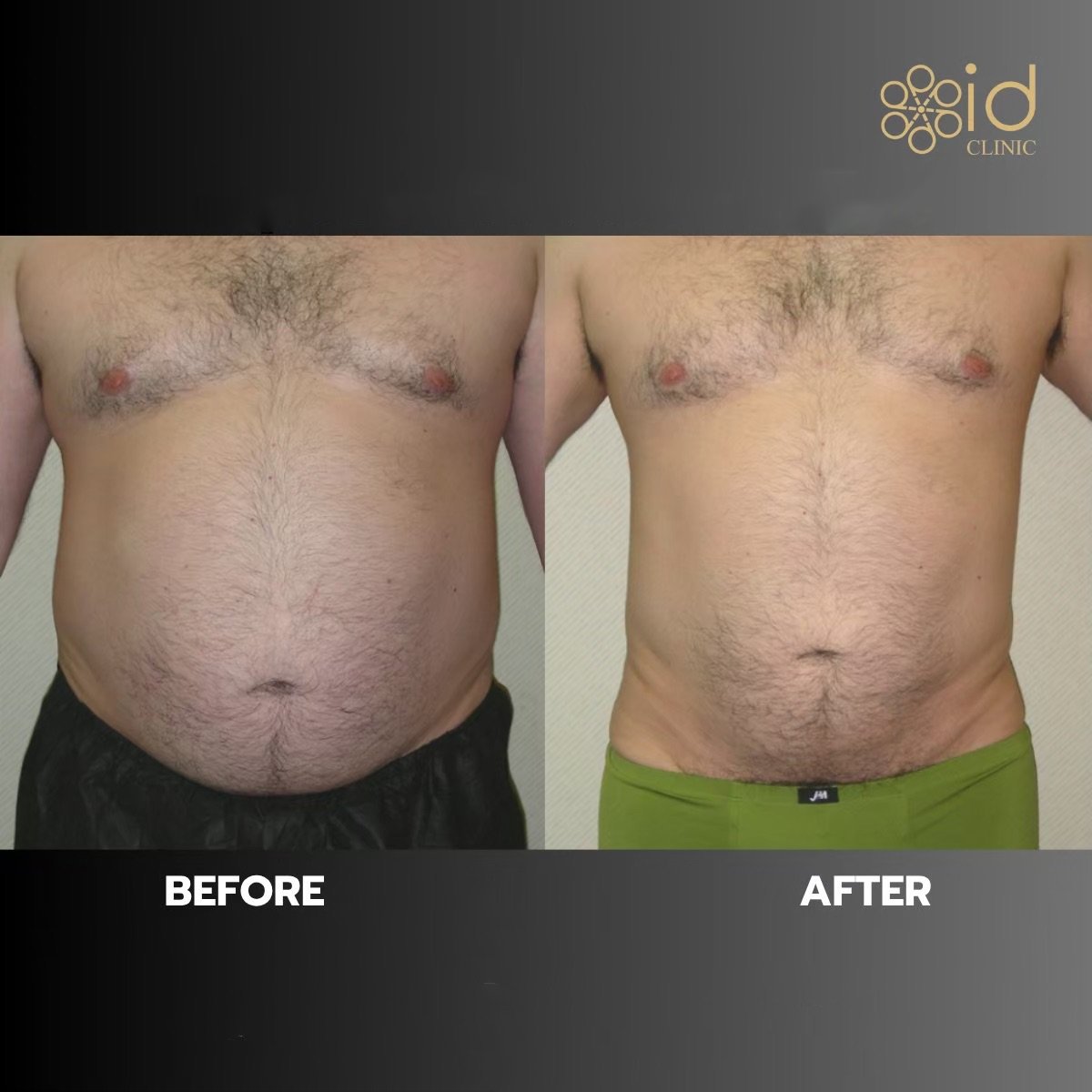 Vorher-nachher-Ergebnis Vaser-Liposuktion bei ID Clinic Bangkok, sichtbare Bauchkontur