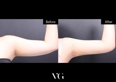 Vorher-nachher-Ergebnis der Armliposuktion bei VG Plastic Surgery – schlankerer Arm
