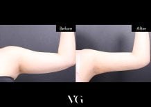 Vorher-nachher-Ergebnis der Armliposuktion bei VG Plastic Surgery – schlankerer Arm