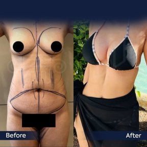 Before and after breast implants with lift at Dr. Safa Manav Clinic, enhanced breast contour result