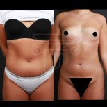 360 liposuction before and after results at Dr. Safa Manav Clinic, visible body contouring