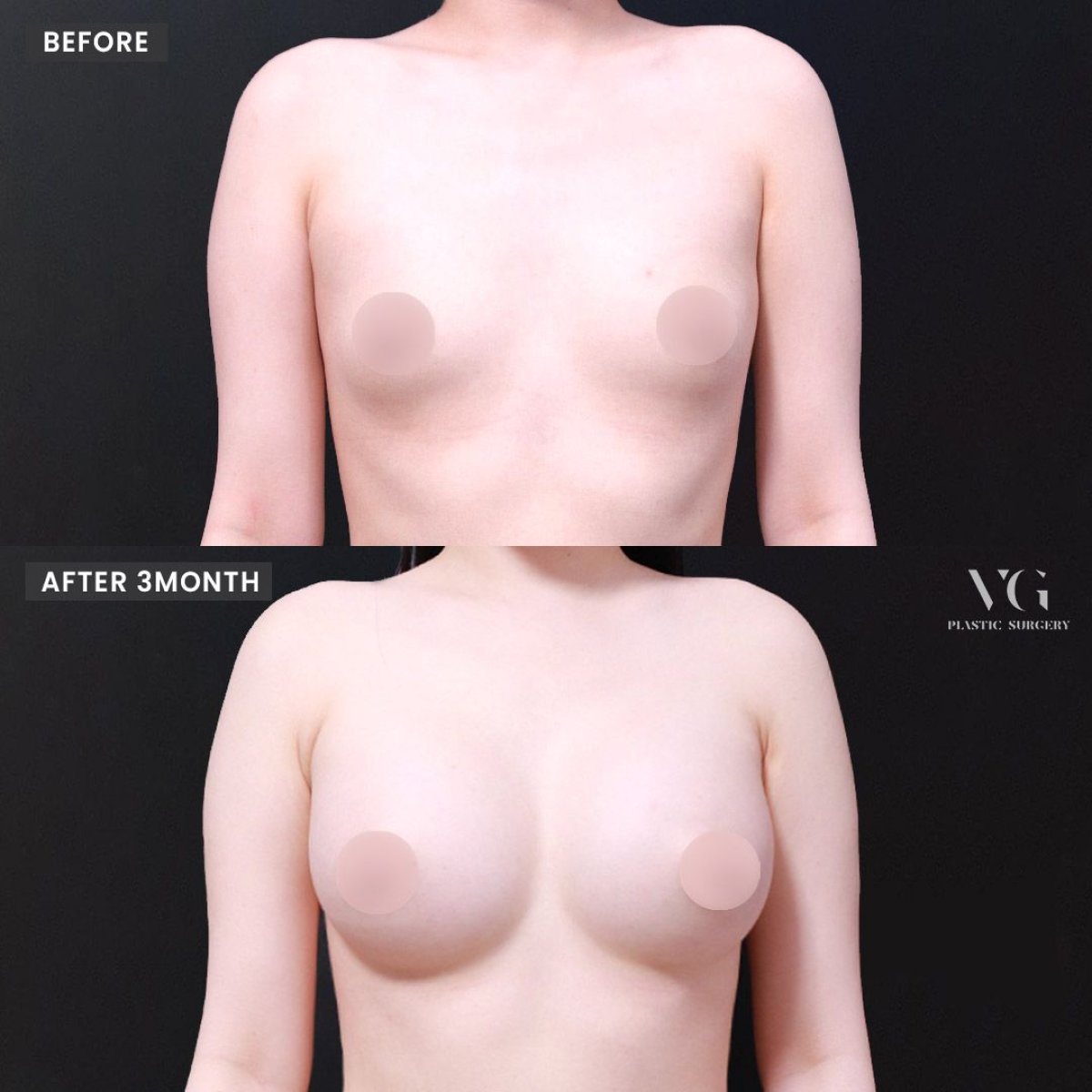 نتائج عملية تكبير الثدي قبل وبعد في VG Plastic Surgery، زيادة واضحة في حجم الثدي