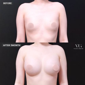 Before and after mammoplasty results at VG Plastic Surgery, visible breast augmentation outcome