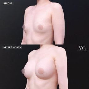 Результати мамопластики до і після у VG Plastic Surgery – помітне збільшення грудей