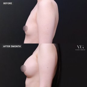 Результаты маммопластики до и после в VG Plastic Surgery – заметное улучшение формы груди