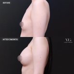 Результаты маммопластики до и после в VG Plastic Surgery – заметное улучшение формы груди