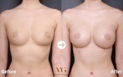 Результати мамопластики до і після у VG Plastic Surgery, помітне збільшення грудей