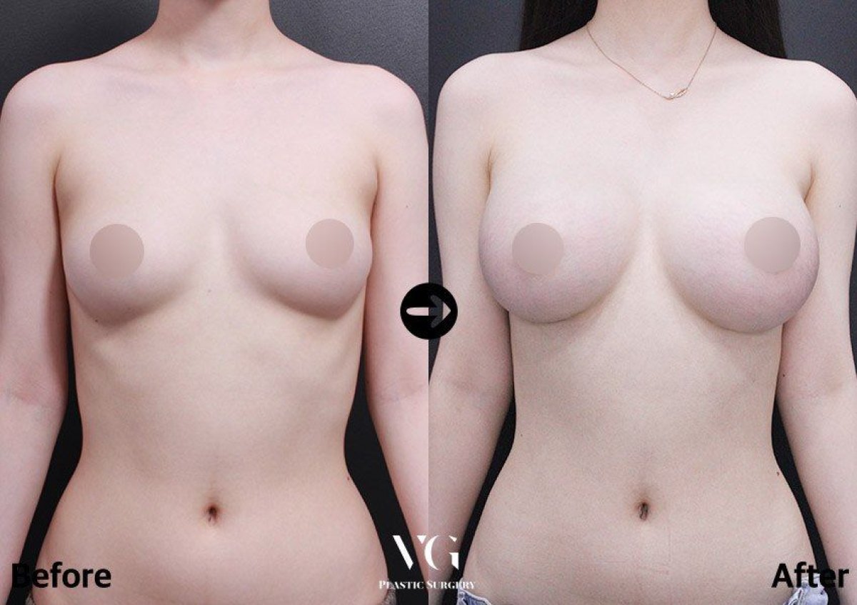 Résultats avant et après mammoplastie chez VG Plastic Surgery – augmentation visible des seins