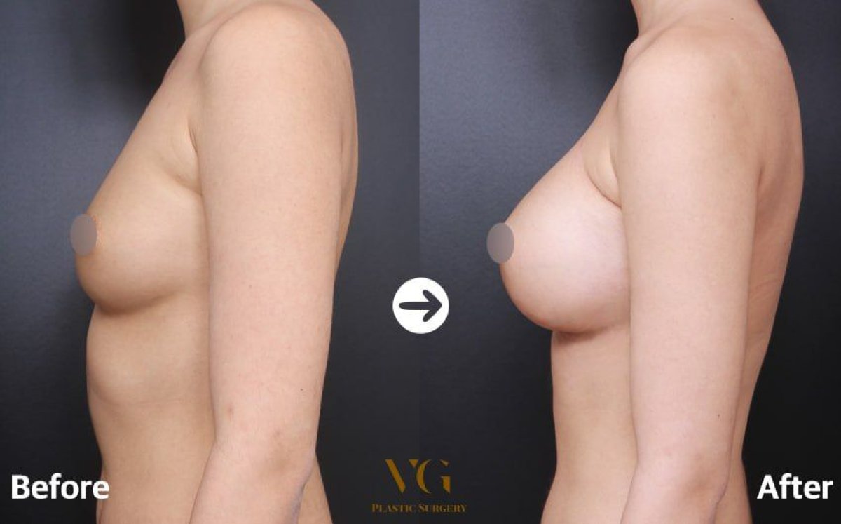 Résultats avant/après de la mammoplastie chez VG Plastic Surgery – augmentation visible des seins