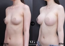 Результаты маммопластики до и после в VG Plastic Surgery – увеличение объема и формы груди