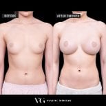 Результаты маммопластики до и после в VG Plastic Surgery, видимое увеличение груди