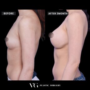 Resultados de mamoplastia antes y después en VG Plastic Surgery, aumento de pecho tras 3 meses