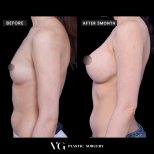 Resultados de mamoplastia antes y después en VG Plastic Surgery, aumento de pecho tras 3 meses