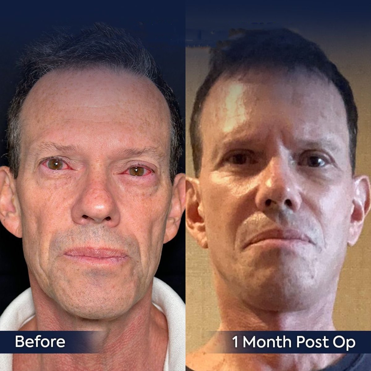Resultados de lifting facial antes y después en Dr. Safa Manav Clinic, 1 mes postoperatorio