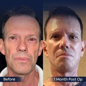 Facelift Vorher-Nachher-Ergebnisse bei Dr. Safa Manav Clinic, 1 Monat nach OP
