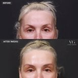 Блефаропластика до и после в VG Plastic Surgery, видимый лифтинг век