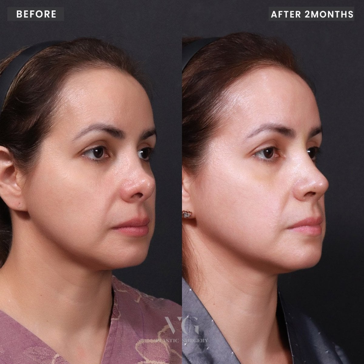 Resultados de rinoplastia antes y después en VG Plastic Surgery, mejora nasal tras 2 meses