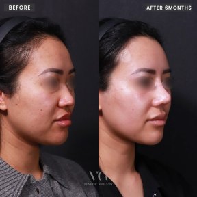 Before and after rhinoplasty results at VG Plastic Surgery, nose reshaping after 6 months