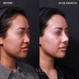 Before and after rhinoplasty results at VG Plastic Surgery, nose reshaping after 6 months