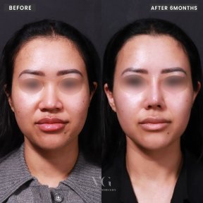 Before and after rhinoplasty results at VG Plastic Surgery, nose reshaping after 6 months