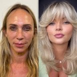 Facelift before and after results at Dr. Safa Manav Clinic – facial rejuvenation transformation