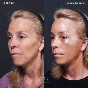 Facelift Vorher-Nachher-Ergebnisse bei VG Plastic Surgery, sichtbare Verjüngung nach 2 Wochen