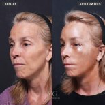 Facelift Vorher-Nachher-Ergebnisse bei VG Plastic Surgery, sichtbare Verjüngung nach 2 Wochen