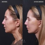 Vorher-nachher-Ergebnis Facelift bei VG Plastic Surgery – sichtbare Verjüngung nach 2 Wochen