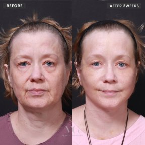 Vorher-nachher-Ergebnis Facelift bei VG Plastic Surgery – sichtbare Verjüngung nach 2 Wochen
