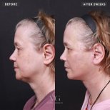 Facelift Vorher-Nachher-Ergebnis bei VG Plastic Surgery – sichtbare Kiefer- und Halsstraffung
